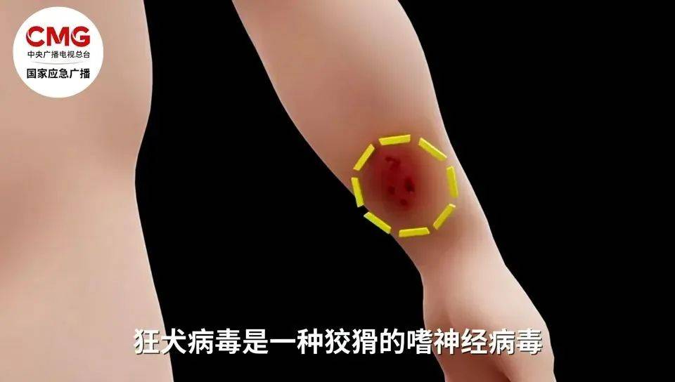手臂肌腱被咬断！近期激增，半个月接诊近200例……